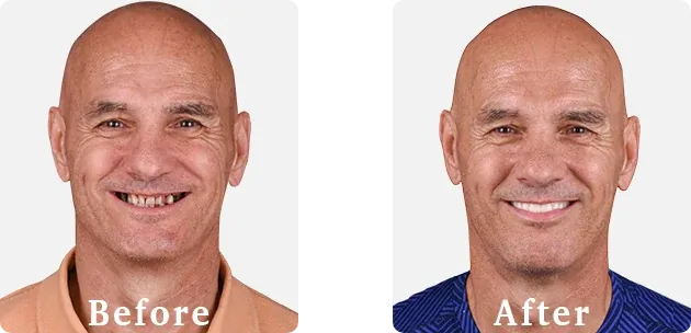 All on 4 dental implants in Cabo San Lucas transform missing teeth into a full, functional smile.