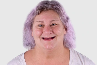 Female patient before cosmetic and restorative dental treatment at Paradise Dentistry Cabo, showing the smile prior to treatment.