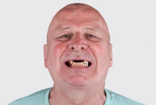 Patient before full-mouth dental restoration at Paradise Dentistry Cabo, showing the condition of the smile prior to treatment.