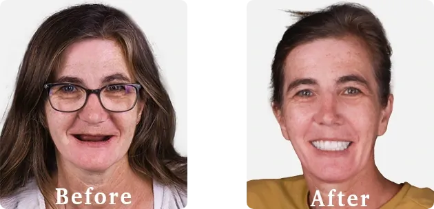 Before and after comparison of patient's smile after treatment at Paradise Dental in Cabo San Lucas.
