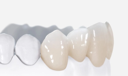 Female patient before cosmetic and restorative dental treatment at Paradise Dentistry Cabo, showing the smile prior to treatment.