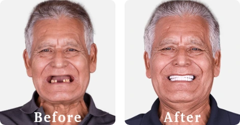 before and after result treatment 3 on 6 implants