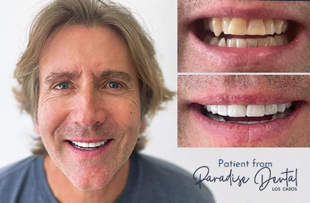 Happy male patient showing his incredible before and after transformation following a dental restoration and smile design treatment.