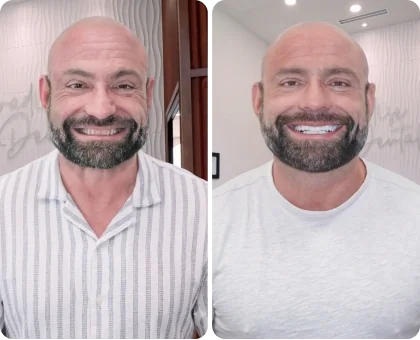 before and after treatment result